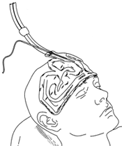 Migraine treatment patent drawing